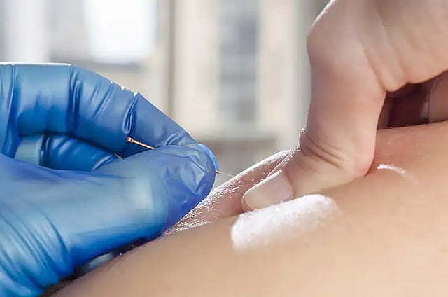 person receiving dry needling treatment