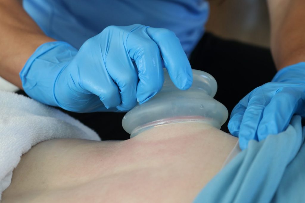 Cupping of muscle tissue to promote blood flow and release tension in the patients back in Cody Wyoming